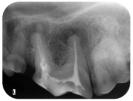 Röntgen von wurzelbehandletem Zahn